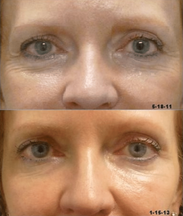 Order Belotero Fillers Under Eyes Rejuvenation Doctor Medica