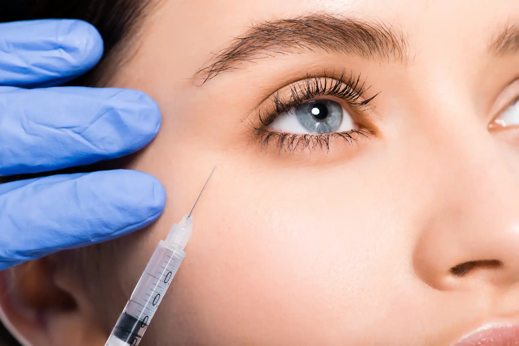 See It To Believe It My Jaw Dropping Juvederm Under Eye Filler Before After - abfp9o9