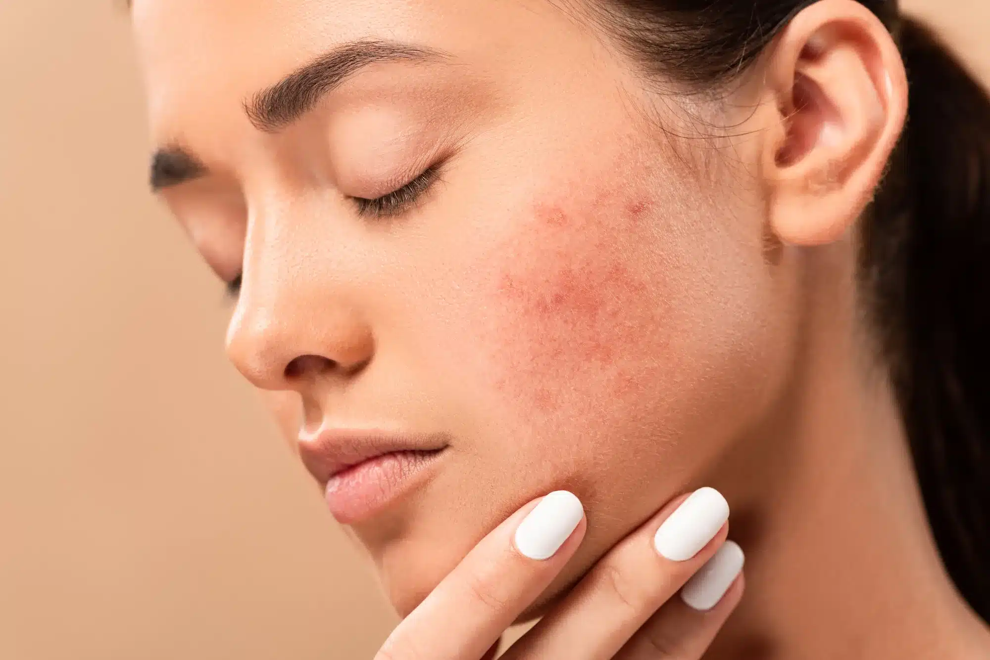 https://shop.doctormedica.co/wp-content/uploads/2023/03/Treatment-with-Restylane-for-Acne-Scars.webp