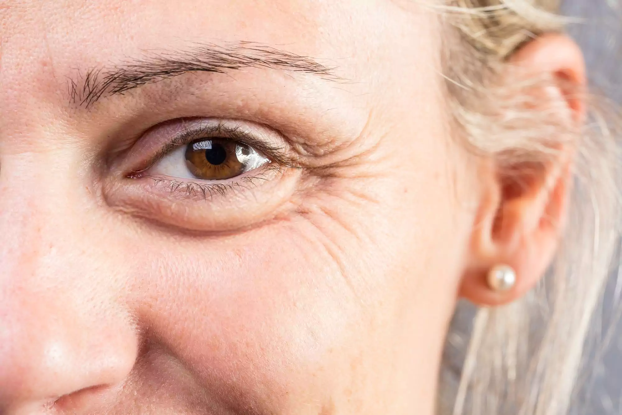 https://shop.doctormedica.co/wp-content/uploads/2023/03/crows-feet-treatment-with-botox-65674b71b42a3.webp