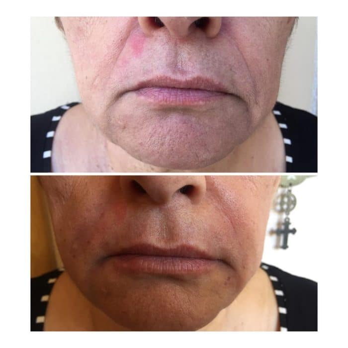 Before and after using Filorga Fillers to address nasolabial folds.