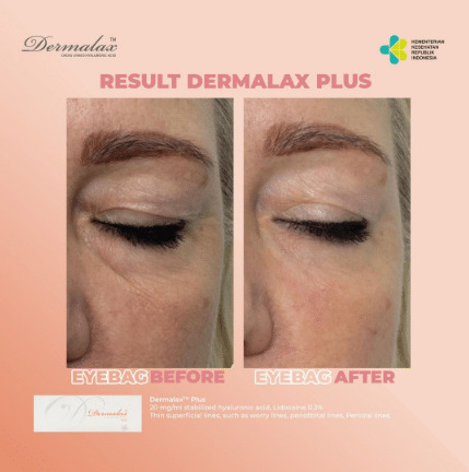 Female patient's eye bags before and after Dermalax Plus.