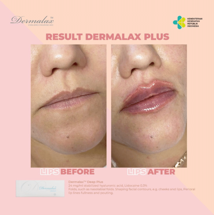 Woman receiving lip augmentation with Dermalax Deep Plus.