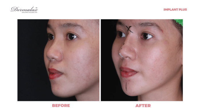 Woman before and after nose augmentation using Dermalax Implant Plus.