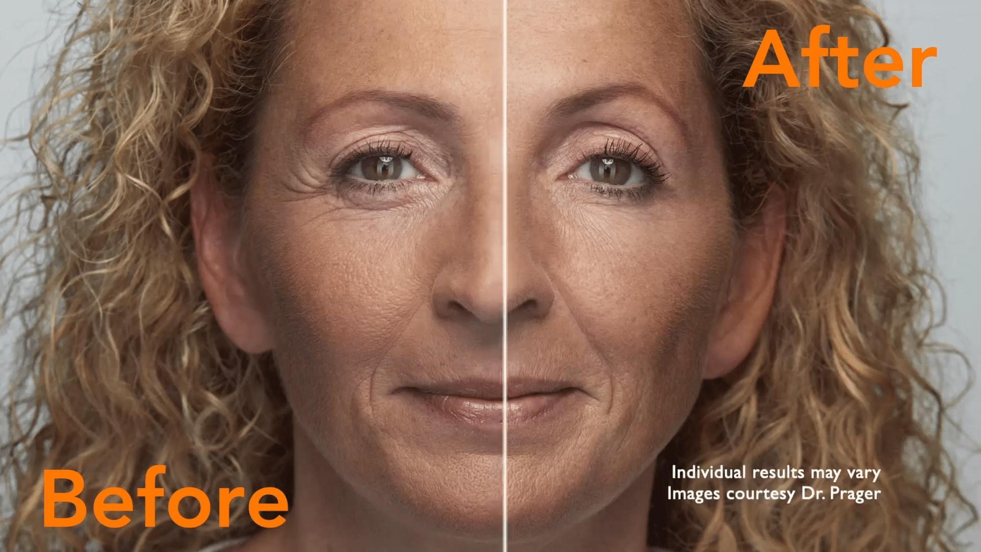 Transformative Results Belotero Before and After Doctor Medica