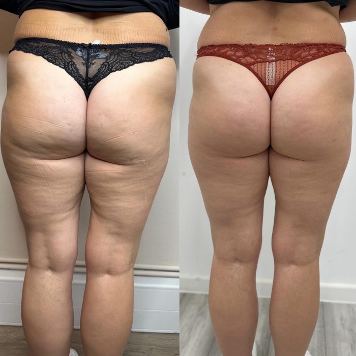 Before and after 5 sessions of Alidya
