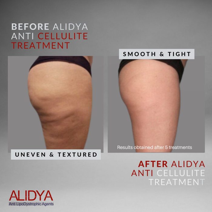 Smoother, tighter skin after 5 sessions of Alidya injections.