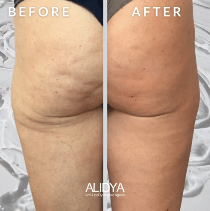 Before and after comparison of Alidya reducing cellulite in the buttocks and thighs.