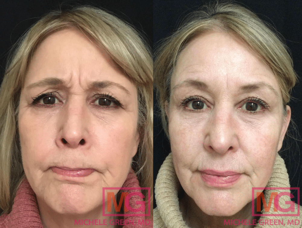 Female patient in her 60s getting Botox to soften the lines and creases on her face.