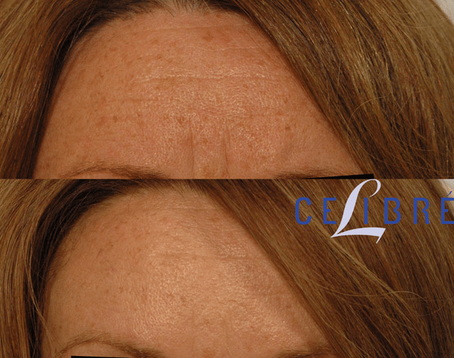 Skin rejuvenation in the forehead area using Botox injections.