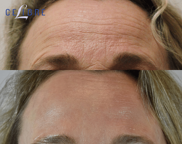 Treating forehead lines with Botox.