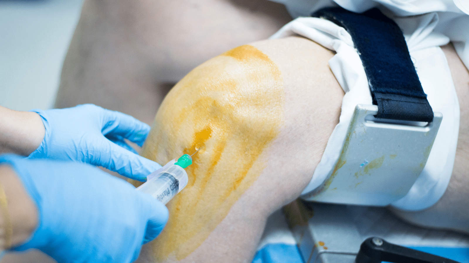 A healthcare provider carefully and strategically injects Orthovisc into the knee joint.