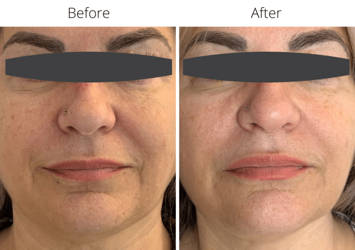 Jalupro skin boosters effectively addressing facial lines.