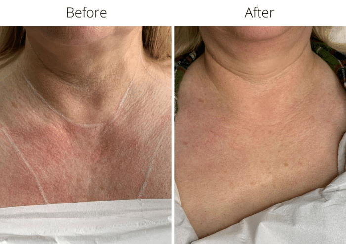 Jalupro skin booster rehydrating and making the skin smooth again.