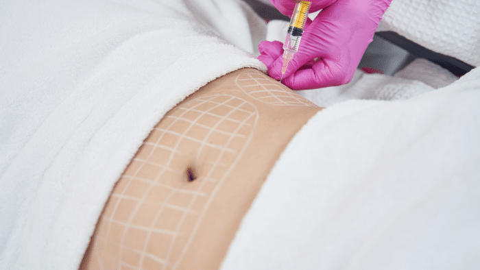 Injecting Hyacorp body filler.