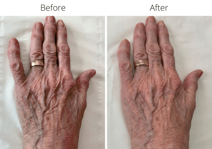 Jalupro delivering rejuvenation to the hands.