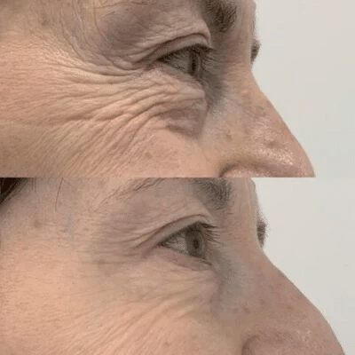 Jalupro to rejuvenate the area around the eyes.