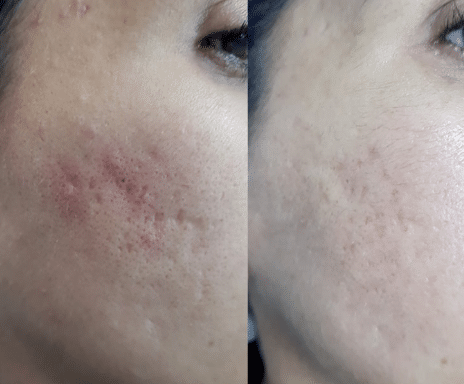 Jalupro treating acne scars.
