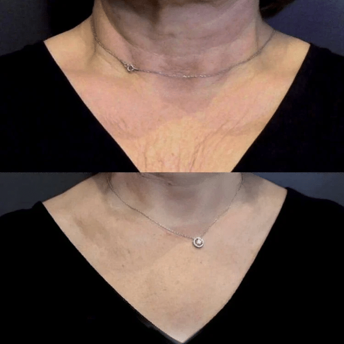 Jalupro results after treating the decolletage area.
