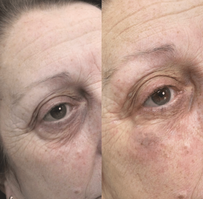 Jalupro for under eye rejuvenation.