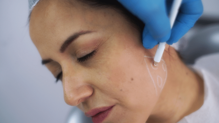 Woman receiving Botox for jawline and chin sculpting.