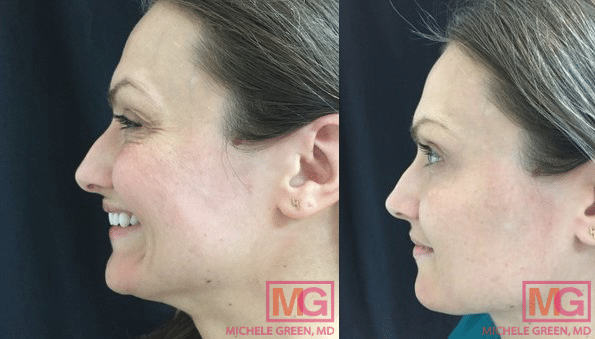 Botox injection to treat crow's feet.