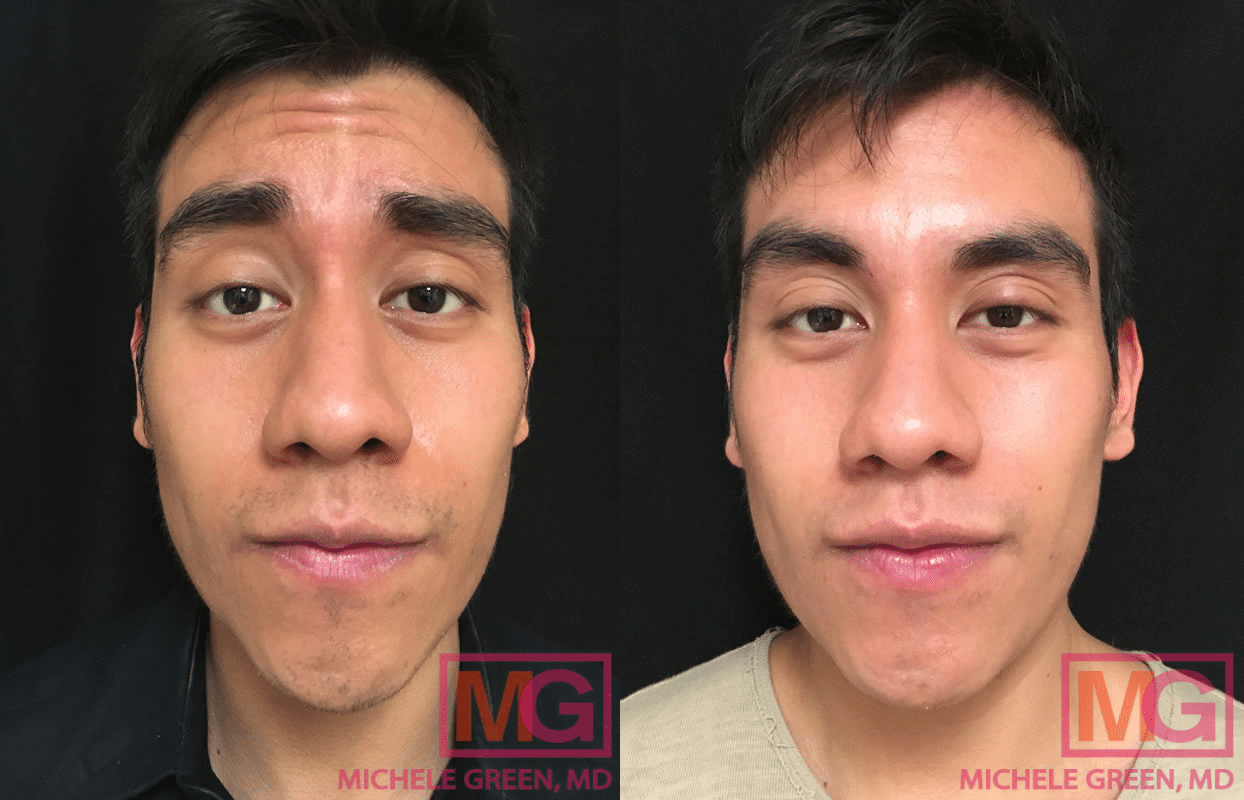 Young male patient getting Botox to address glabellar lines.