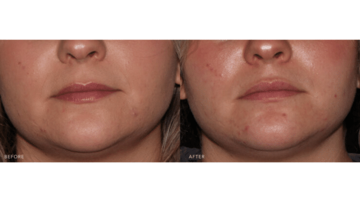 Before and after of treatment. 