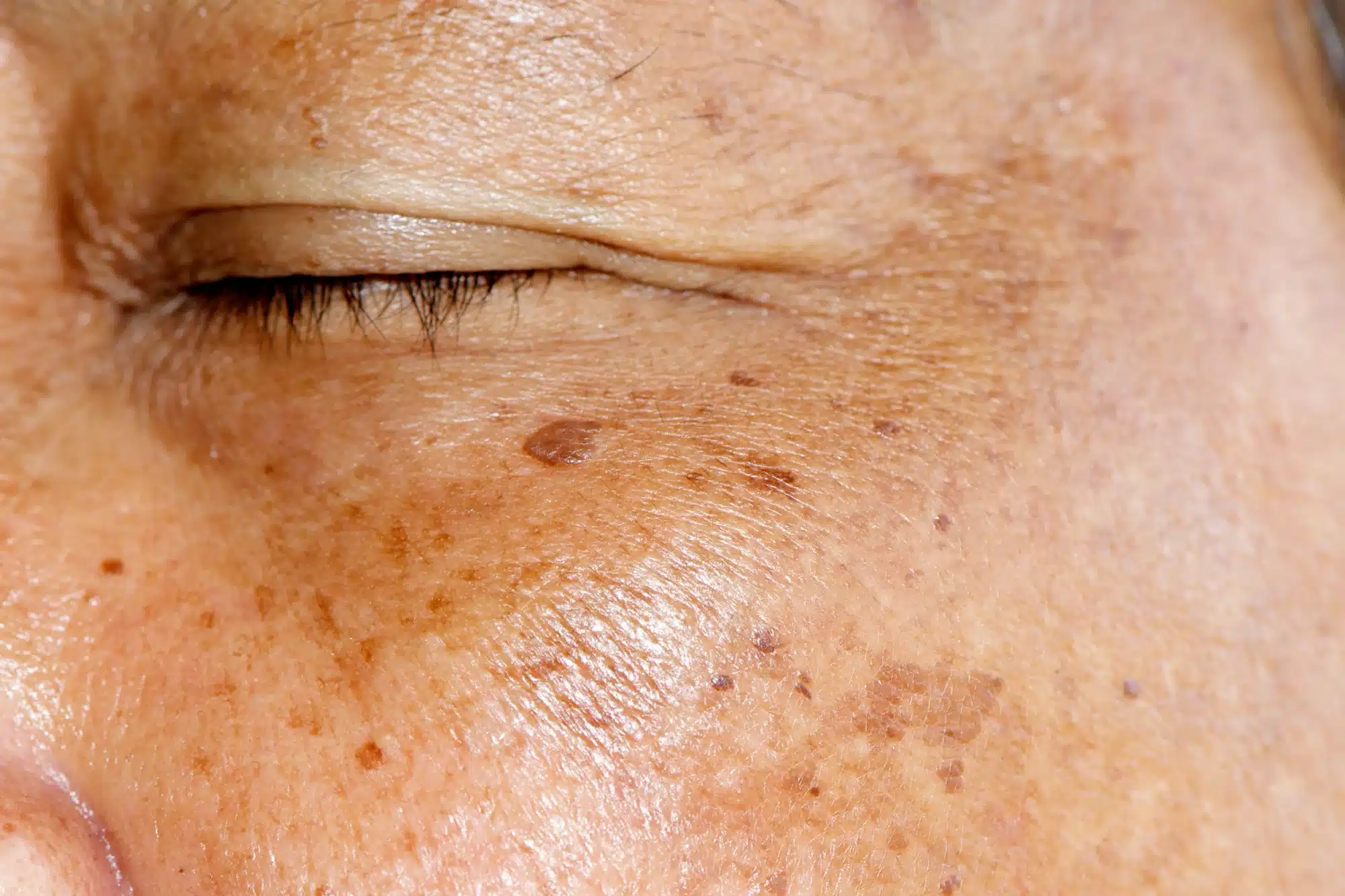 https://shop.doctormedica.co/wp-content/uploads/2024/09/Botox-The-New-Melasma-Treatment-Option.webp