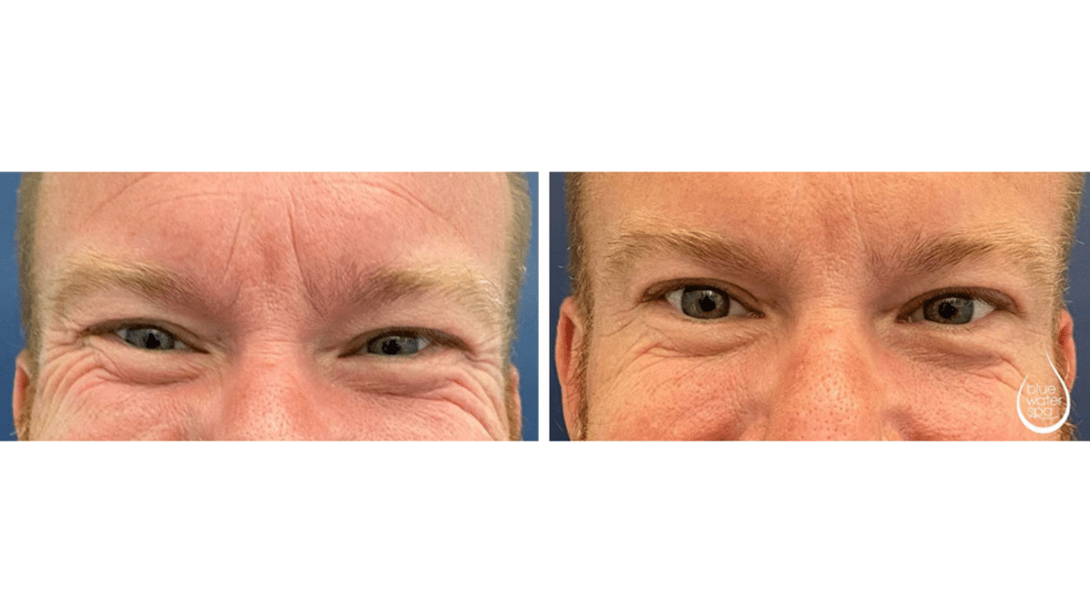 Nabota Botox Reviews and Information - DoctorMedica