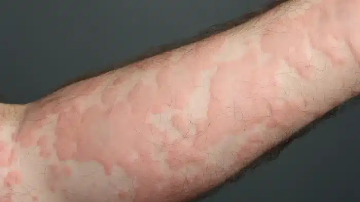 Allergy. 