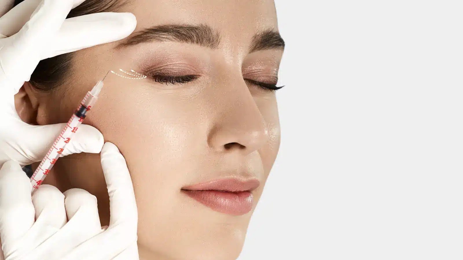 Sculptra treatment areas.
