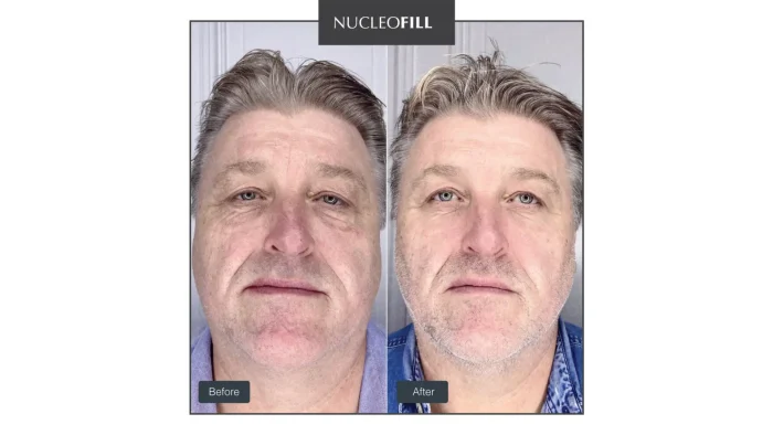 Nucleofill Before and After 1