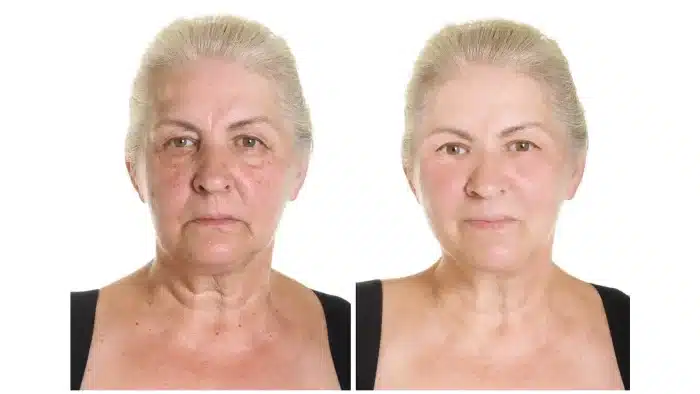 Nucleofill Before and After 2