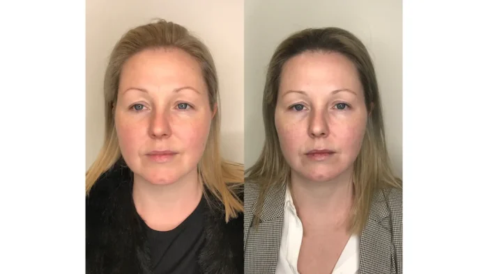 Patient Experiences and Longevity of Results 1
