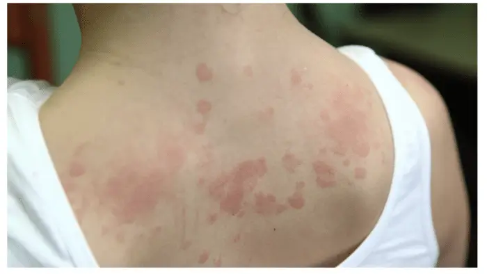 Rare Side Effects of Harmonyca Fillers