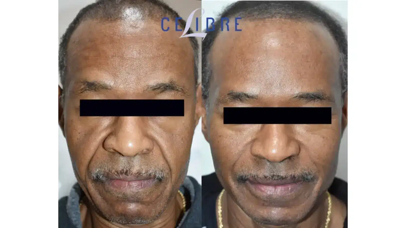 Sculptra Before and After Photos 1