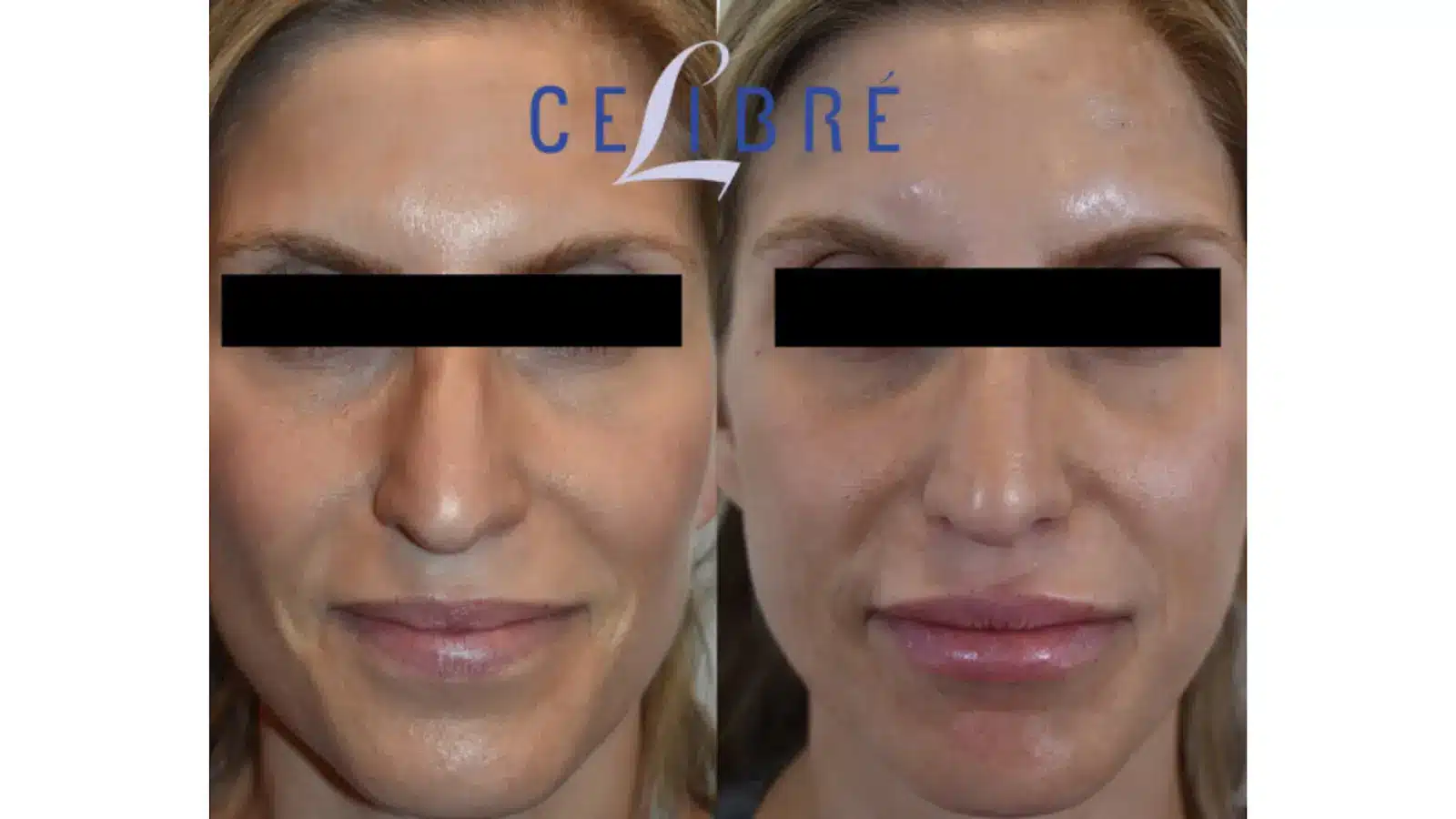 Sculptra Before and After Photos 2