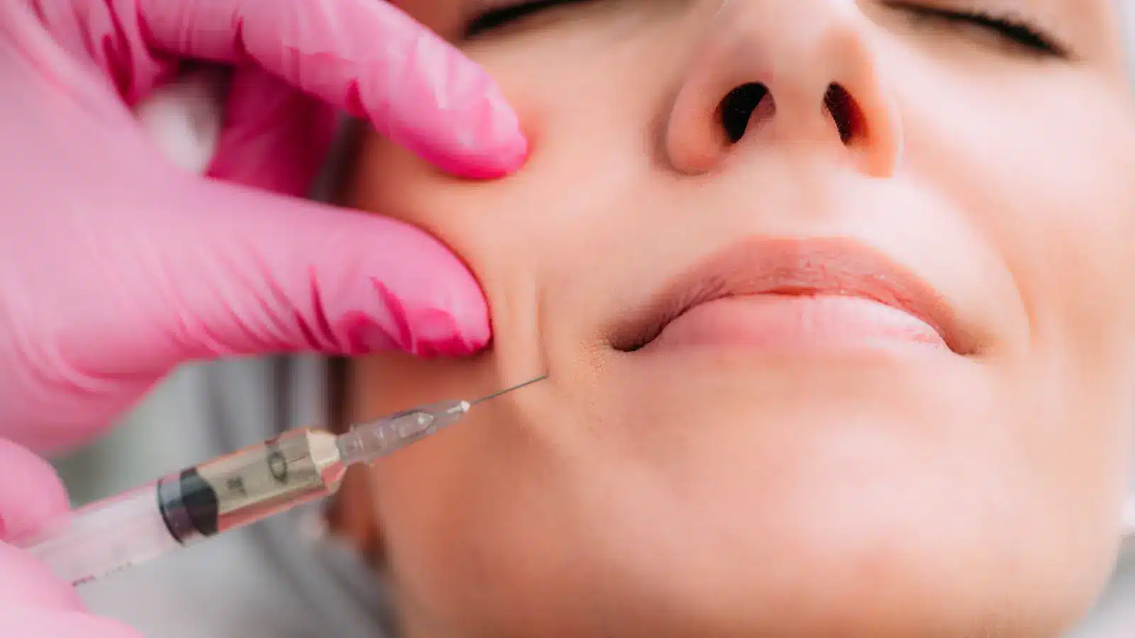 Nasolabial fold injection. 