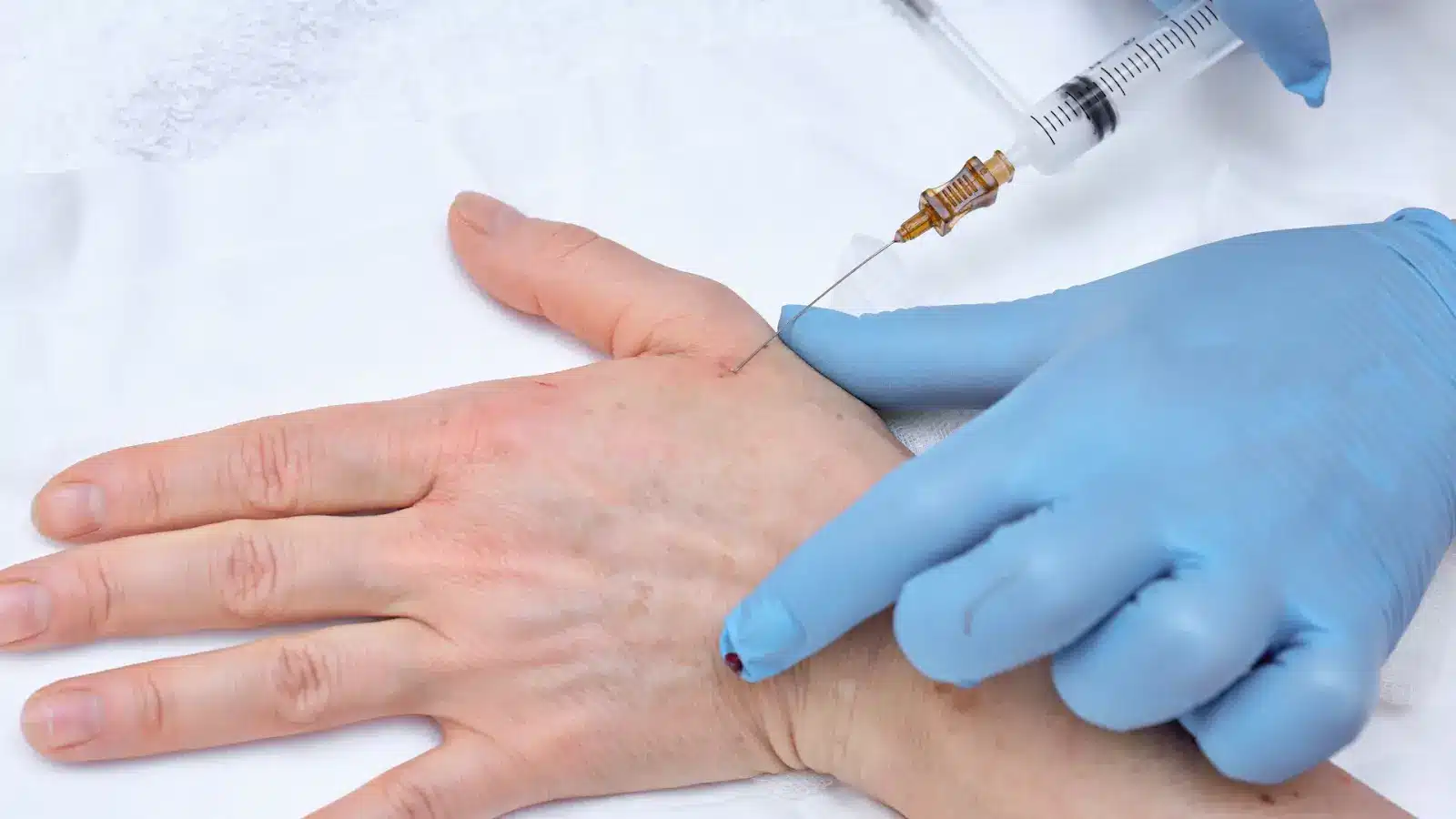 A medical expert injects filler into a patient's hand.