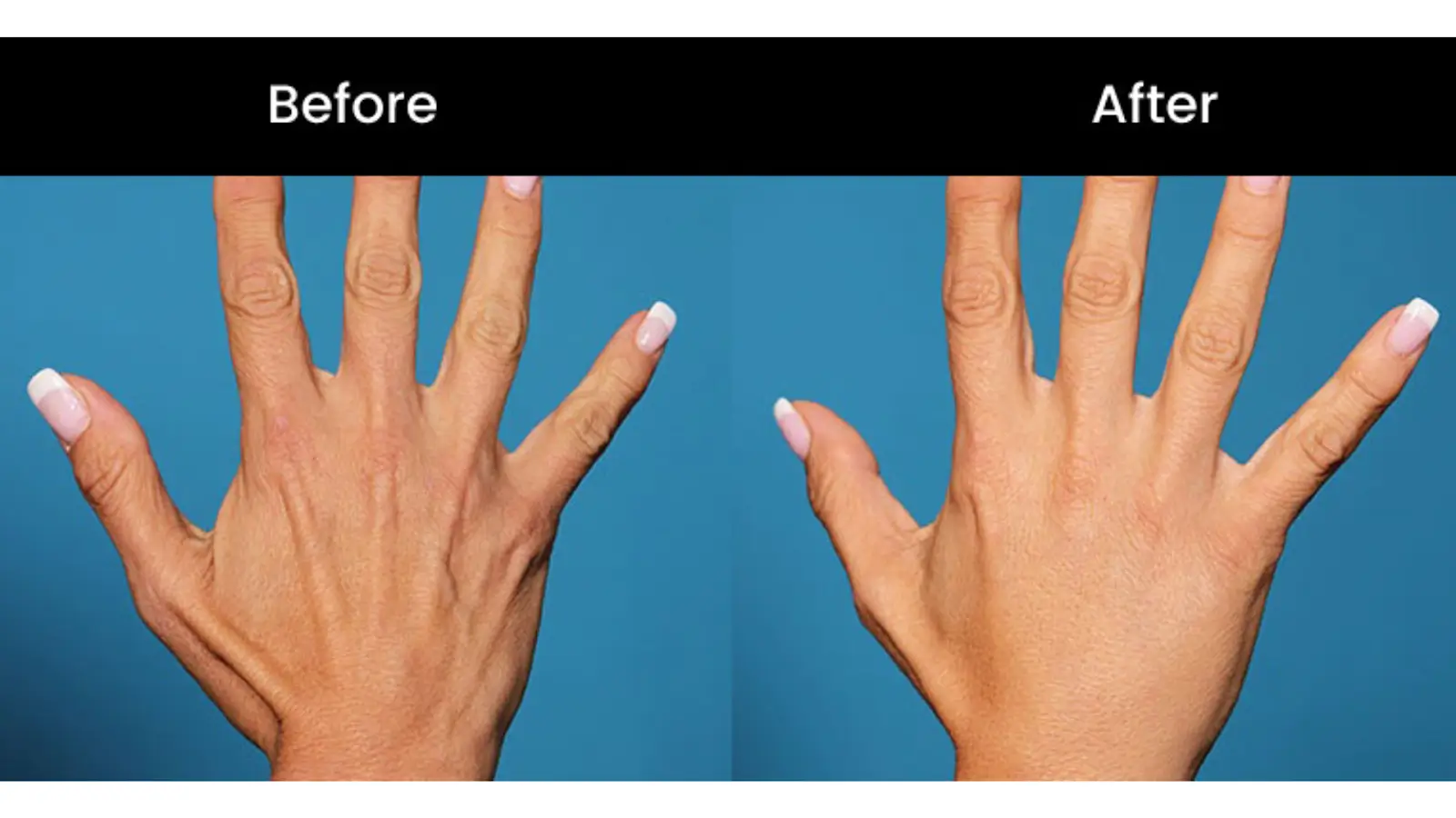 Sculptra hand treatment before and after comparison