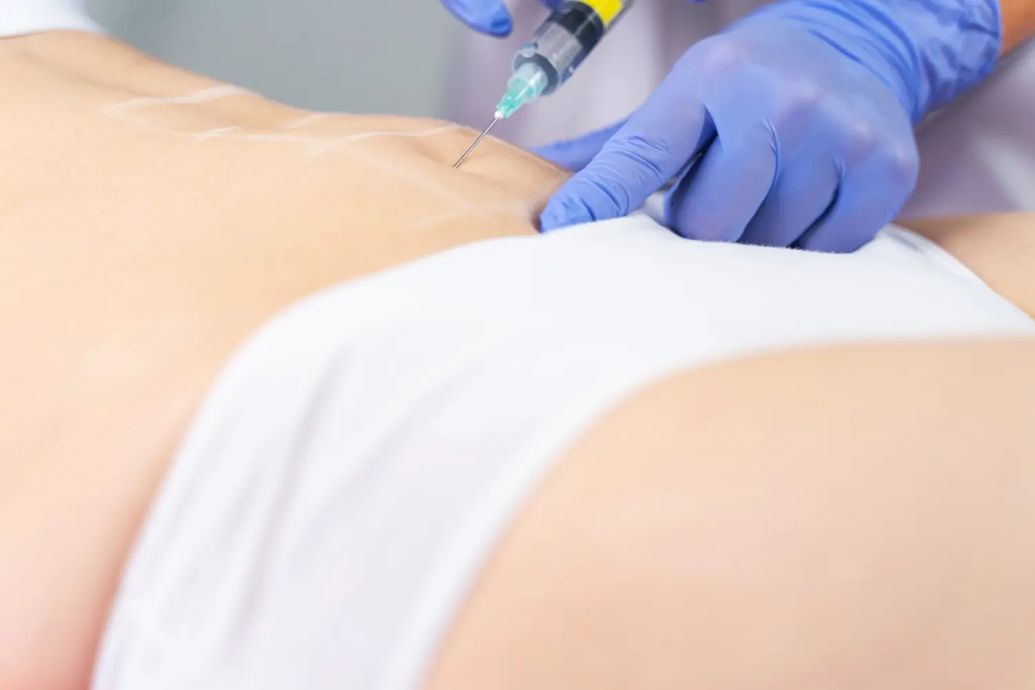 Sculpting injection targeting the stomach area.
