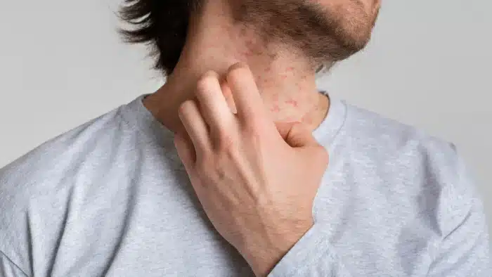 Allergic reaction to skin booster injection