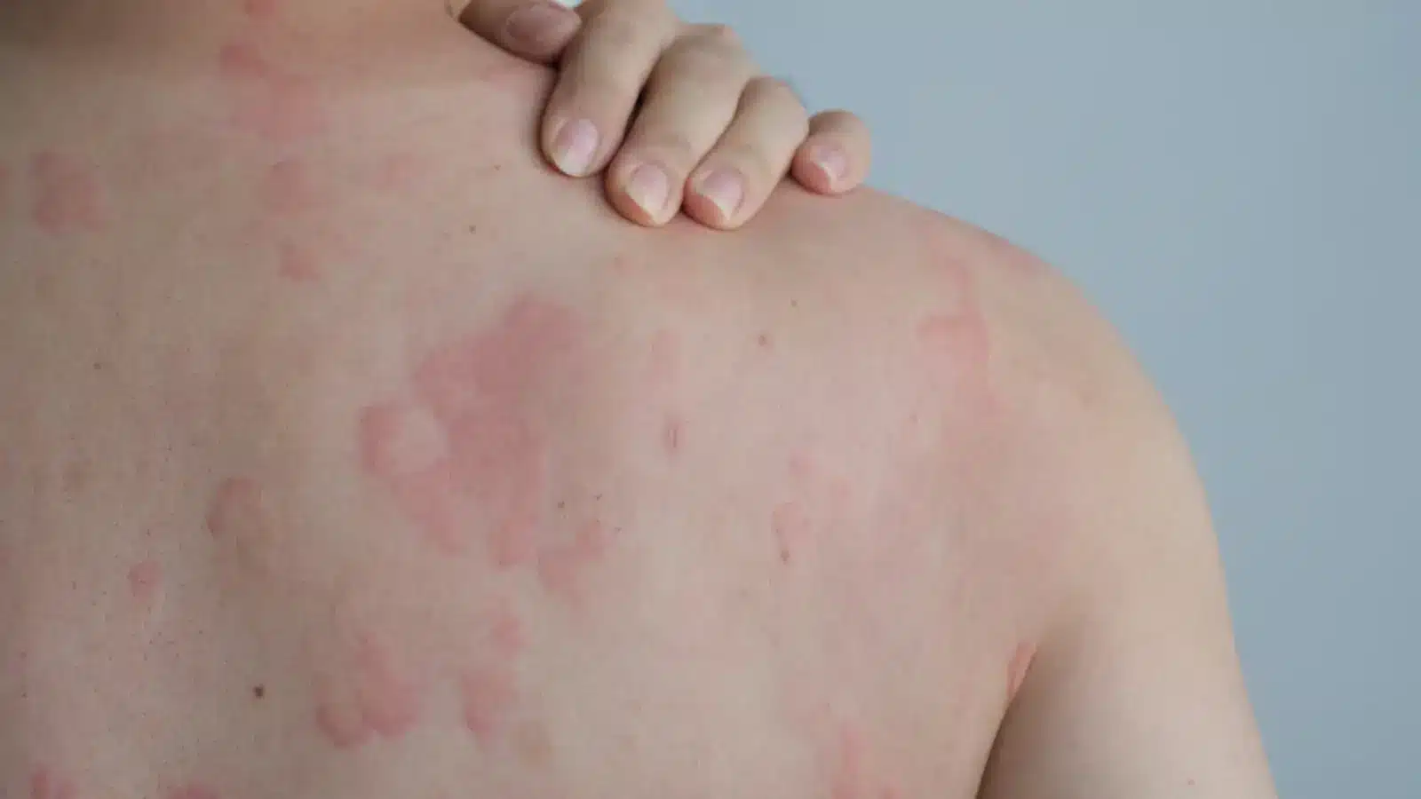 Itching caused by allergic reaction.