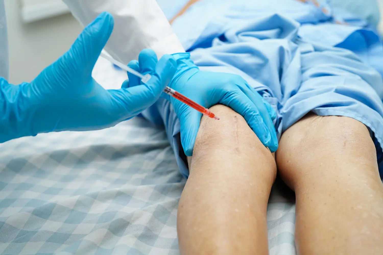 Knee injection to treat osteoarthritis.