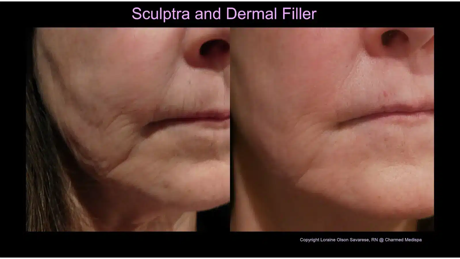 Sculptra Patient Testimonials and Experiences 2