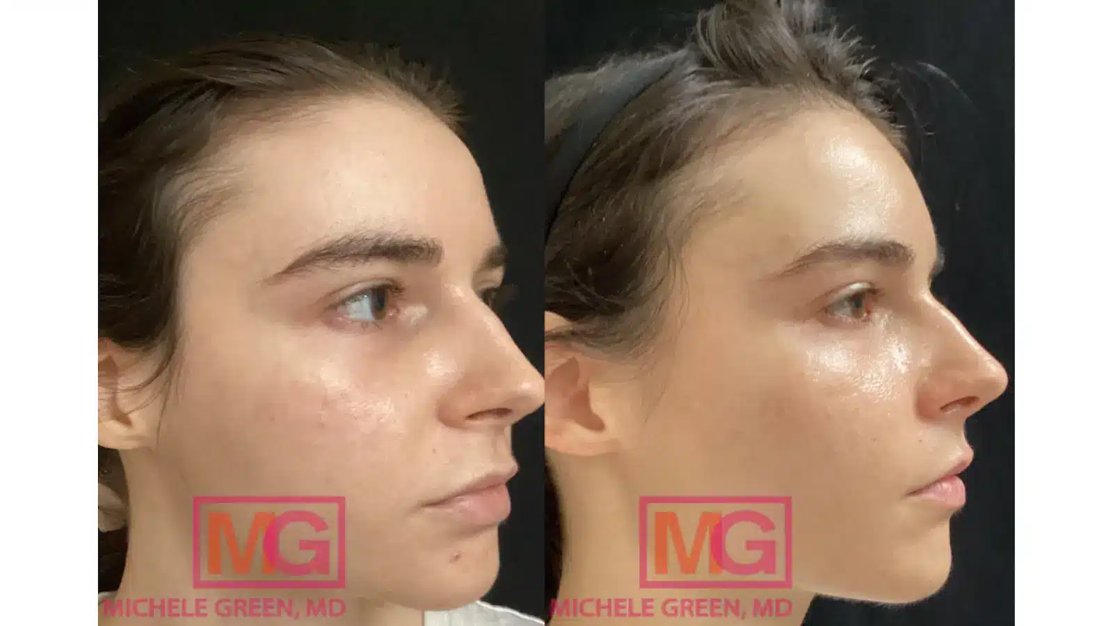 Sculptra Patient Testimonials and Experiences
