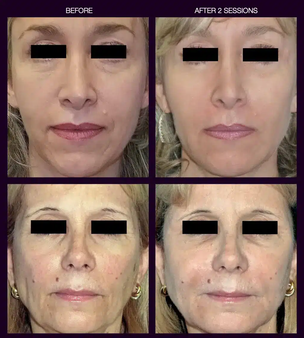 Before and After of Cytocare treatment.