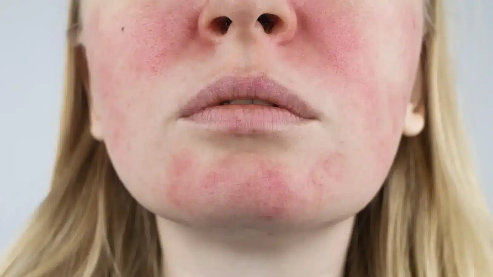 Woman with redness on her face. 