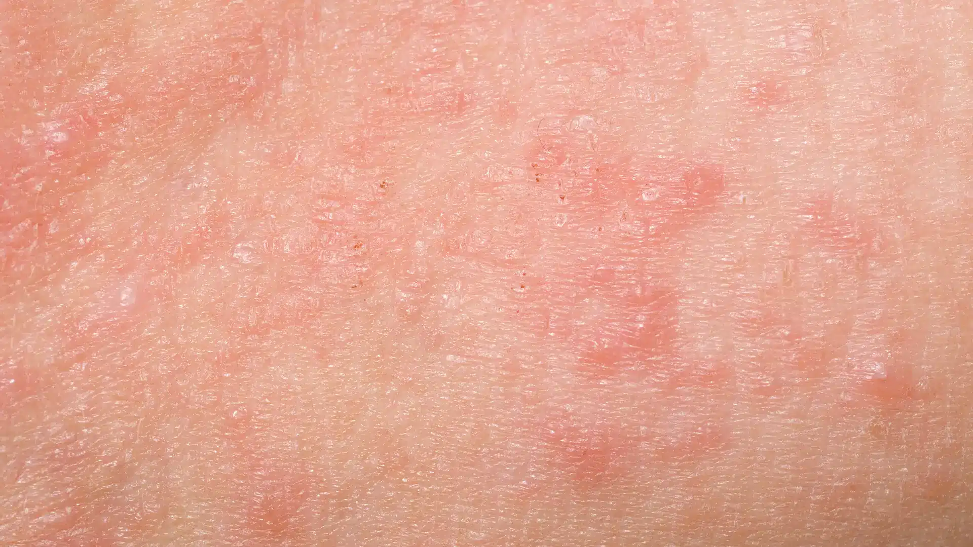 Redness around the injection site following filler treatment